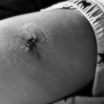 Stitches