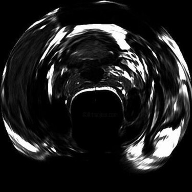摄影 标题为“cancer 007” 由Johan Kause, 原创艺术品